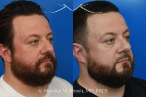 Photo of a patient before and after a procedure. Functional & Cosmetic Septo-Rhinoplasty with Nasal Valve Repair - This gentleman suffered from chronic nasal obstruction, which worsened with exercise, and his right nostril collapsed during deep inhalation. His nasal bridge was deviated to the left, and the tip was bulbous. A septo-rhinoplasty was performed to correct these issues. A deviated septum was repaired, and a right-sided spreader graft was used to straighten the nasal bridge. Nostril collapse was corrected with a combination of cephalic trimming of the alar cartilages and alar strut grafts, which also improved the cosmetic appearance of the nasal tip.