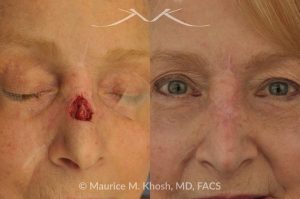 Photo of a patient before and after a procedure. Repair of Moh's skin cancer defect of nose - Reconstruction of nose after basal cell cancer excision.
