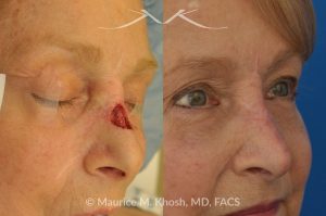 Photo of a patient before and after a procedure. Repair of Moh's skin cancer defect of nose - Reconstruction of nose after basal cell cancer excision.