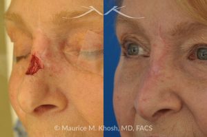 Photo of a patient before and after a procedure. Repair of Moh's skin cancer defect of nose - Reconstruction of nose after basal cell cancer excision.