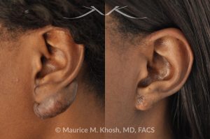 Photo of a patient before and after a procedure. Keloid Ear - before and after treatment results.