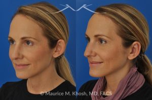Photo of a patient before and after a procedure. Bilateral Otoplasty to Correct Protruding Ears and Improve Symmetry - This delightful 34 year old wanted to improve her protuberant ears. The left ear stuck out more than the right side. Otoplasty or ear pinning surgery was done in our office in Manhattan, under local anesthesia. Both ears were pushed back to a natural position. Symmetry between the position of two ears was achieved. 