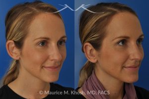 Photo of a patient before and after a procedure. Bilateral Otoplasty to Correct Protruding Ears and Improve Symmetry - This delightful 34 year old wanted to improve her protuberant ears. The left ear stuck out more than the right side. Otoplasty or ear pinning surgery was done in our office in Manhattan, under local anesthesia. Both ears were pushed back to a natural position. Symmetry between the position of two ears was achieved. 