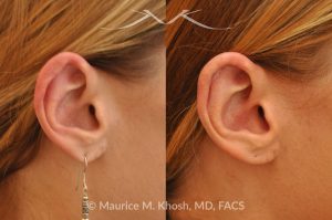 Photo of a patient before and after a procedure. Revision Otoplasty - before-and-after composite photo.