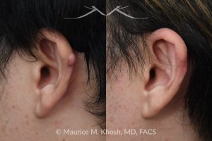 Photo of a patient before and after a procedure. Ear Keloid Removal 1 - Removal of a small l keloid along the helical rim and repair of the skin. 