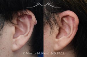 Photo of a patient before and after a procedure. Ear Keloid Removal 1 - Removal of a small l keloid along the helical rim and repair of the skin. 