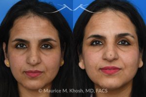 Photo of a patient before and after a procedure. Left Forehead Osteoma removal — No Visible Scar 1 - A large left sided upper forehead osteoma was removed through an invisible incision within the hairline. 