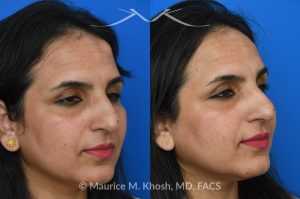 Photo of a patient before and after a procedure. Left Forehead Osteoma removal — No Visible Scar 1 - A large left sided upper forehead osteoma was removed through an invisible incision within the hairline. 