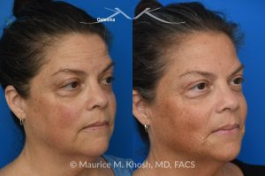 Photo of a patient before and after a procedure. Left Upper Forehead Osteoma Removal Without a Visible Scar 1 - Left upper forehead osteoma was removed through an invisible incision within the hearline. 