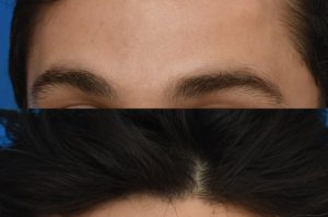 Photo of a patient before and after a procedure. Osteoma Removal Without a Visible Scar 1 - Left mid forehead osteoma was removed through an invisible incision inside the hairline. 
