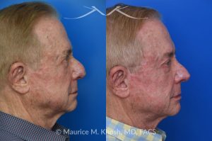 Photo of a patient before and after a procedure. Comprehensive Rhinoplasty and Brow Symmetry Restoration After Forehead Flap Reconstruction - This gentleman sought consultation for enhancement of the nose and increased symmetry in the position of his eyebrows. He had previously undergone excision of a large skin cancer from the right lower nose which was reconstructed with a left forehead flap (skin from the forehead was moved to the nose to cover the surgical defect). The flap resulted in a puffy appearing lower nose and exacerbated the droopy and deviated appearing nasal tip. Additionally, skin removal from the forehead elevated the position of the left eyebrow and resulted in a wide scar in the left upper forehead. 
During rhinoplasty surgery, the contour of the bridge and the tip of was improved and the puffy appearing flap was thinned. The brow lift surgery helped to elevate the right brow to match the position of the left eyebrow. The wide scar in the left forehead was eliminated. 